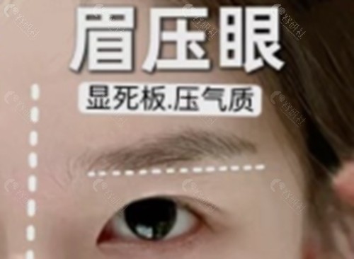 眉压眼做额部提升好还是做切眉好？