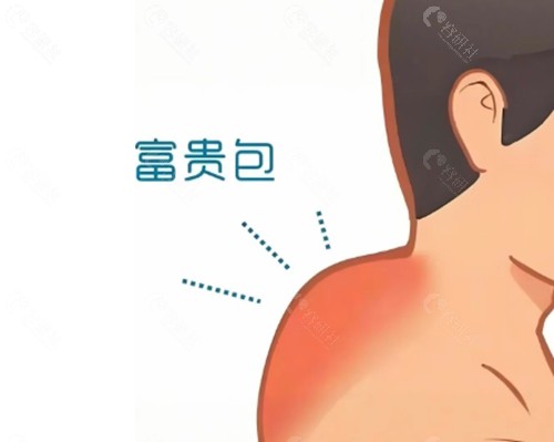 南宁连美医疗美容 富贵包手术好吗