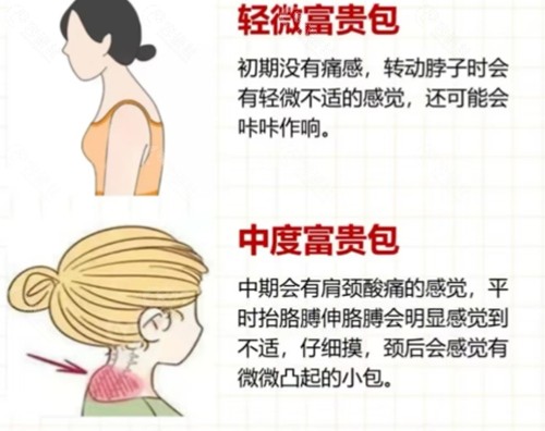 南宁帕拉美医疗美容做富贵包手术怎么样