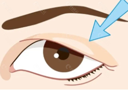 上眼皮松弛下垂做双眼皮好吗？