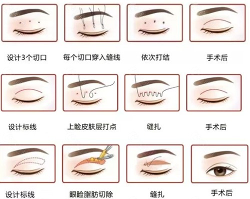 乐山军大整形美容做双眼皮好吗