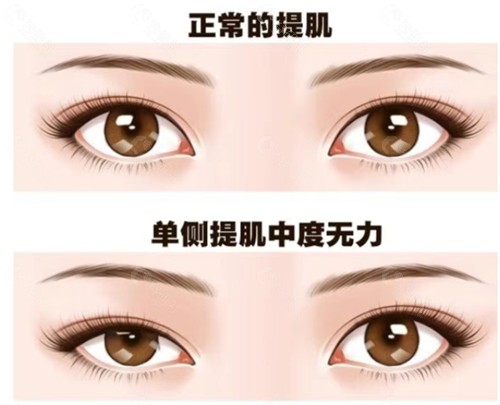 乐山模漾医疗美容做双眼皮好吗