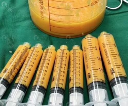 彭才学医生脂肪隆胸的核心技术特色 彭才学医生脂肪隆胸的核心技术特色