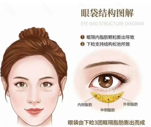 眶隔脂肪释放术去眼袋会反弹吗? 眶隔脂肪释放术去眼袋会反弹吗?
