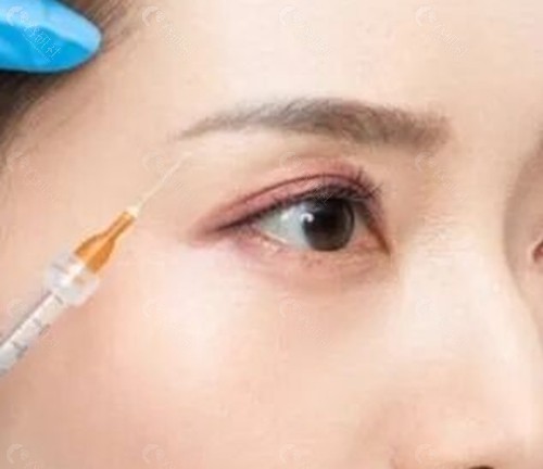眼部凹陷胶原蛋白好还是脂肪好？