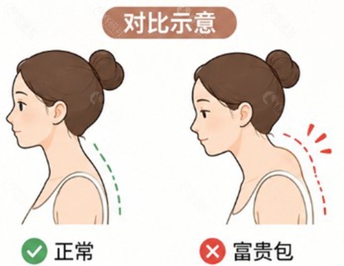 为什么富贵包推荐微创手术,而不是传统抽脂或开刀? 为什么富贵包推荐微创手术,而不是传统抽脂或开刀?