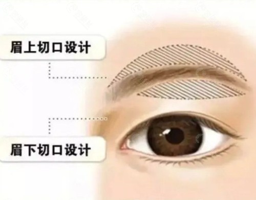 什么是微创提眉手术?它的适应症是什么? 什么是微创提眉手术?它的适应症是什么?