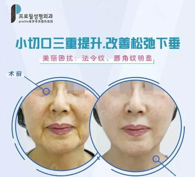 韩国普罗菲耳小切口三重埋线提升术后优势 韩国普罗菲耳小切口三重埋线提升术后优势