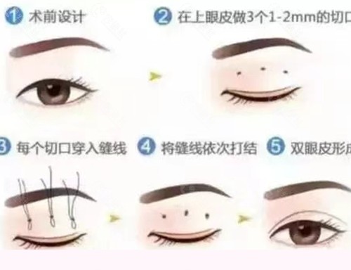 江阴华星医疗美容割双眼皮好吗 江阴华星医疗美容割双眼皮好吗
