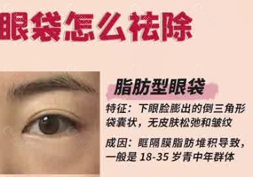 脂肪型眼袋做手术好还是激光好? 脂肪型眼袋做手术好还是激光好?