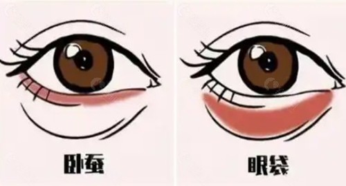 视觉与解剖学辨析：眼睛卧蚕和眼袋的区别图片对比