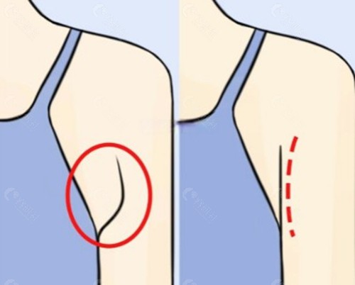 韩国副乳矫正手术费用需要多少钱？