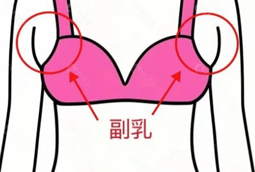 韩国副乳矫正手术哪家好