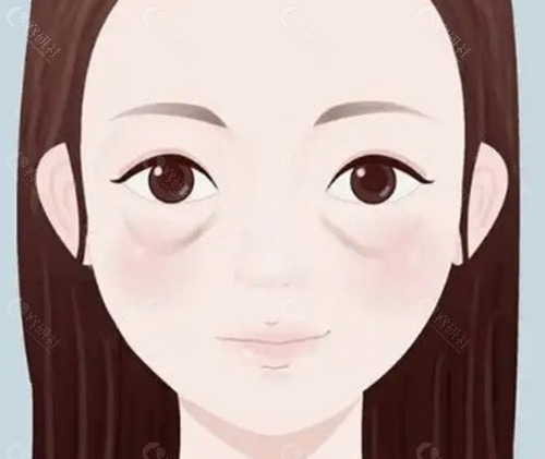谭琳琳眼周赋活抗衰是打玻尿酸吗