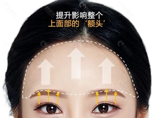 韩国Yourtime 整形医院额头提升好吗