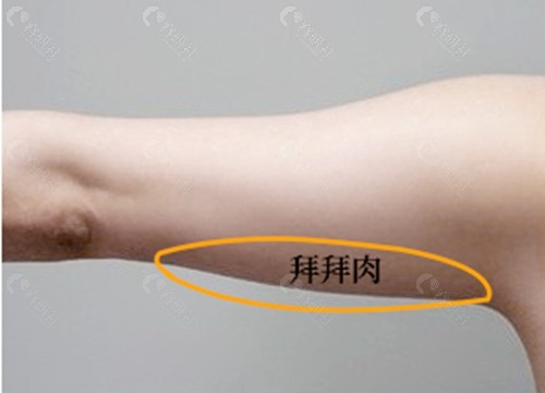 手臂吸脂能瘦多少厘米 手臂吸脂能瘦多少厘米