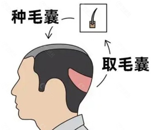 厦门植发1000个毛囊的真实价格体系