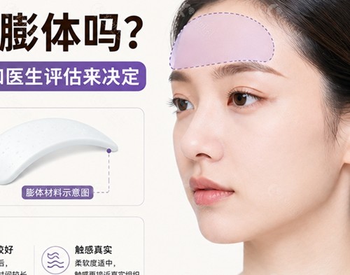 额头填充可以用膨体吗? 额头填充可以用膨体吗?