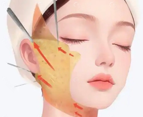 拉皮手術後“顯假僵硬”的底層醫學成因 拉皮手術後“顯假僵硬”的底層醫學成因
