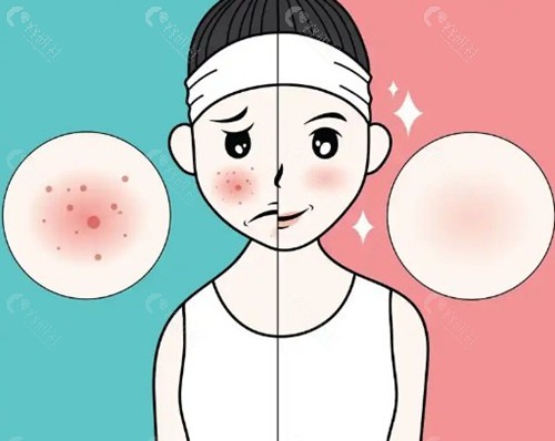 5大韩国名院的抗痘特色技术 5大韩国名院的抗痘特色技术
