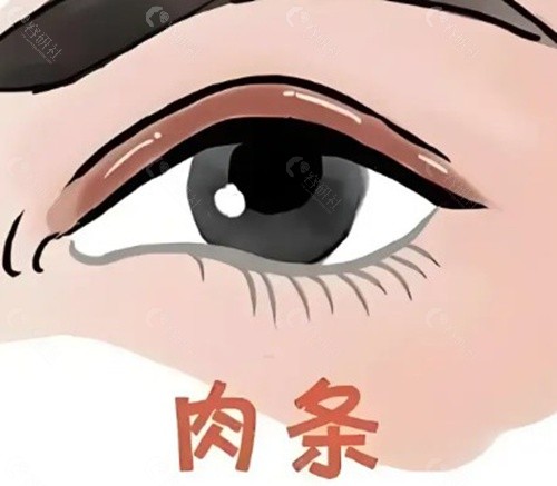 双眼皮术后肉条原因解析 双眼皮术后肉条原因解析