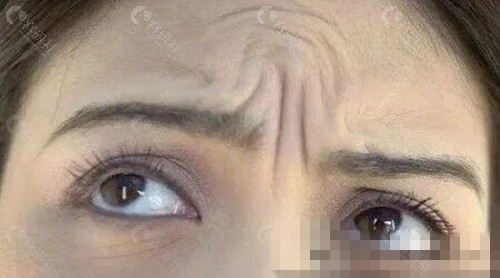 额头除皱的主流医美项目有哪些? 额头除皱的主流医美项目有哪些?