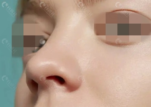 李超鼻子修复技术好吗
