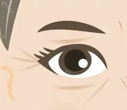 眼睛下面有皱纹,打针究竟可以管多久? 眼睛下面有皱纹,打针究竟可以管多久?