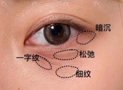 韩国眼下皱纹注射哪家医院好? 韩国眼下皱纹注射哪家医院好?