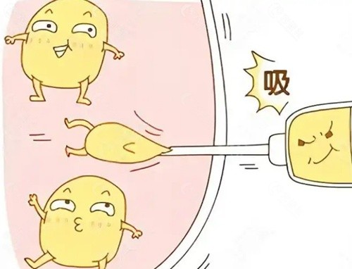 成都华生铂悦威塑吸脂价格是多少？