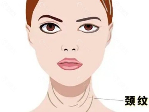 北京颈阔肌折叠术收费价格全解析 北京颈阔肌折叠术收费价格全解析