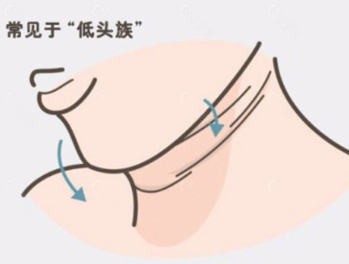 韩国五大热门机构颈部拉皮与下颌缘紧致特色盘点 韩国五大热门机构颈部拉皮与下颌缘紧致特色盘点