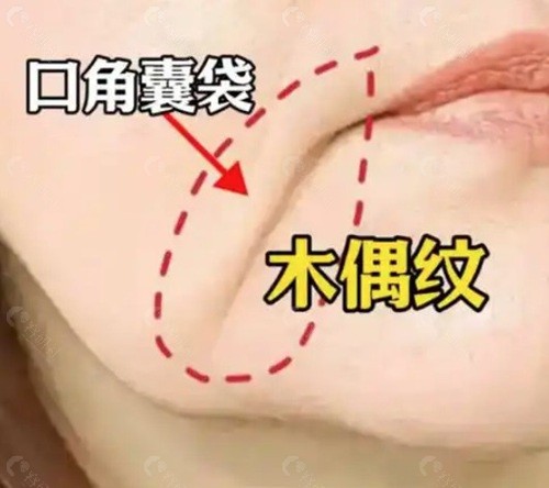 韩国改善木偶纹的价格 韩国改善木偶纹的价格