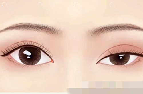 双眼皮褶皱不一样怎么修复? 双眼皮褶皱不一样怎么修复?