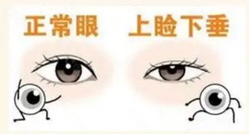 上眼睑提肌手术到底能不能让眼睛变大？