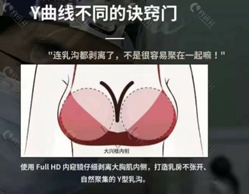 韩国普罗菲耳整形外科隆胸好吗 韩国普罗菲耳整形外科隆胸好吗