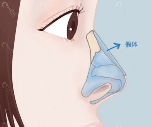 田秋梅医生“穿带榫结构搭建”与“微创分层剥离” 田秋梅医生“穿带榫结构搭建”与“微创分层剥离”