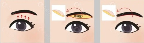 韩国眉下切口提眉术四大高口碑名院特色盘点