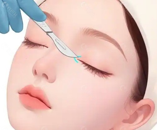 吴焱秋双眼皮修复技术好吗? 吴焱秋双眼皮修复技术好吗?