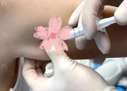 手臂粗打溶脂针好还是肉毒好？