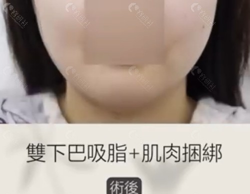 韩国Yourtime吸脂瘦脸好吗