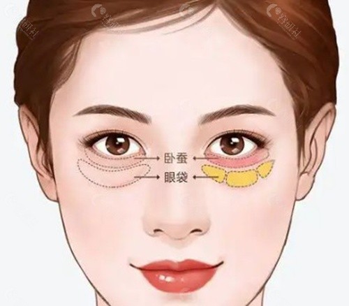 我的眼皮有点松，但不想割双眼皮，陈医生的眉弓注射真的能提上去吗？