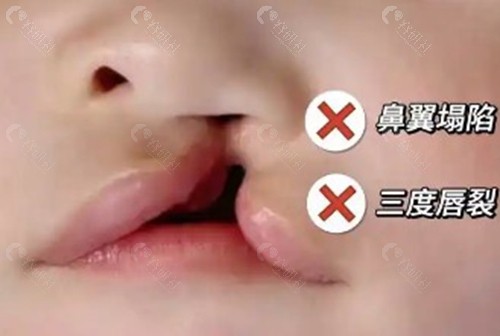 余文林：唇鼻联合修复与“五层减张缝合”