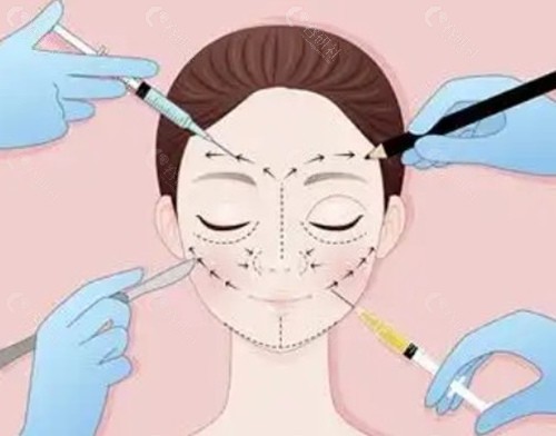 韩国做筋膜折叠提升术大概要多少钱? 韩国做筋膜折叠提升术大概要多少钱?