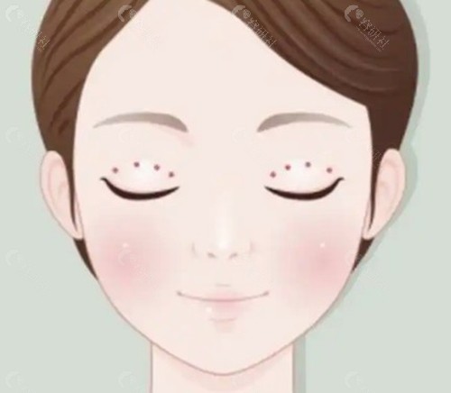 长沙何玮医生双眼皮埋线修复怎么样? 长沙何玮医生双眼皮埋线修复怎么样?