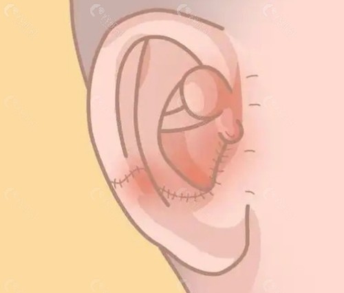 韩国耳整形名气口碑极佳的三大代表机构与特色盘点 韩国耳整形名气口碑极佳的三大代表机构与特色盘点