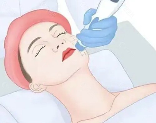 钛提升和热玛吉哪个提升好一点？
