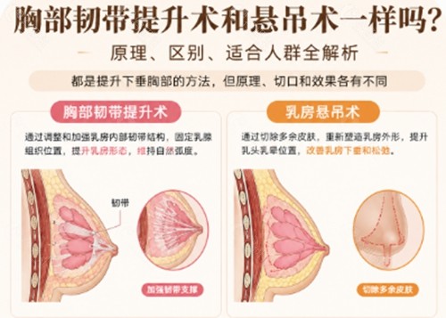 胸部韧带提升术和悬吊术一样吗? 胸部韧带提升术和悬吊术一样吗?