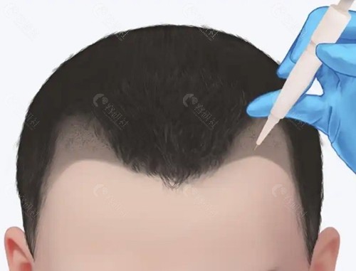 孝感植发多少钱?拒绝“一口价”,看懂计费逻辑 孝感植发多少钱?拒绝“一口价”,看懂计费逻辑