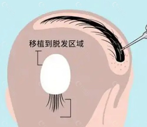 孝感植发哪家好?三大热门机构深度测评 孝感植发哪家好?三大热门机构深度测评